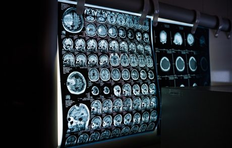 Pollution, alimentation, mode de vie : comment mieux protéger le cerveau face aux maladies neurodégénératives